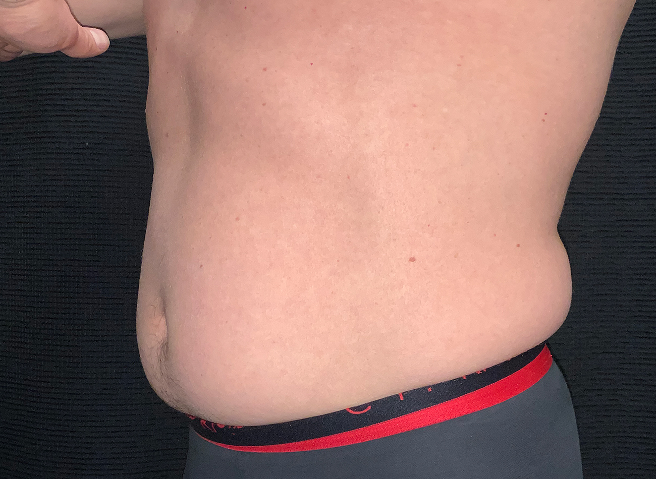 Patient #65839-2: CoolSculpting After Image