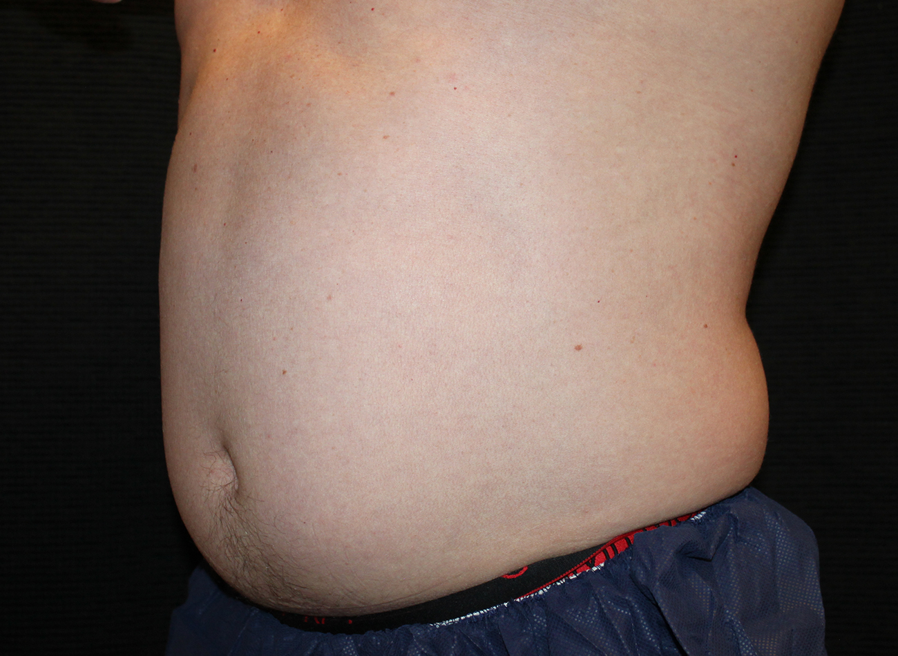 Patient #65839-2: CoolSculpting Before Image