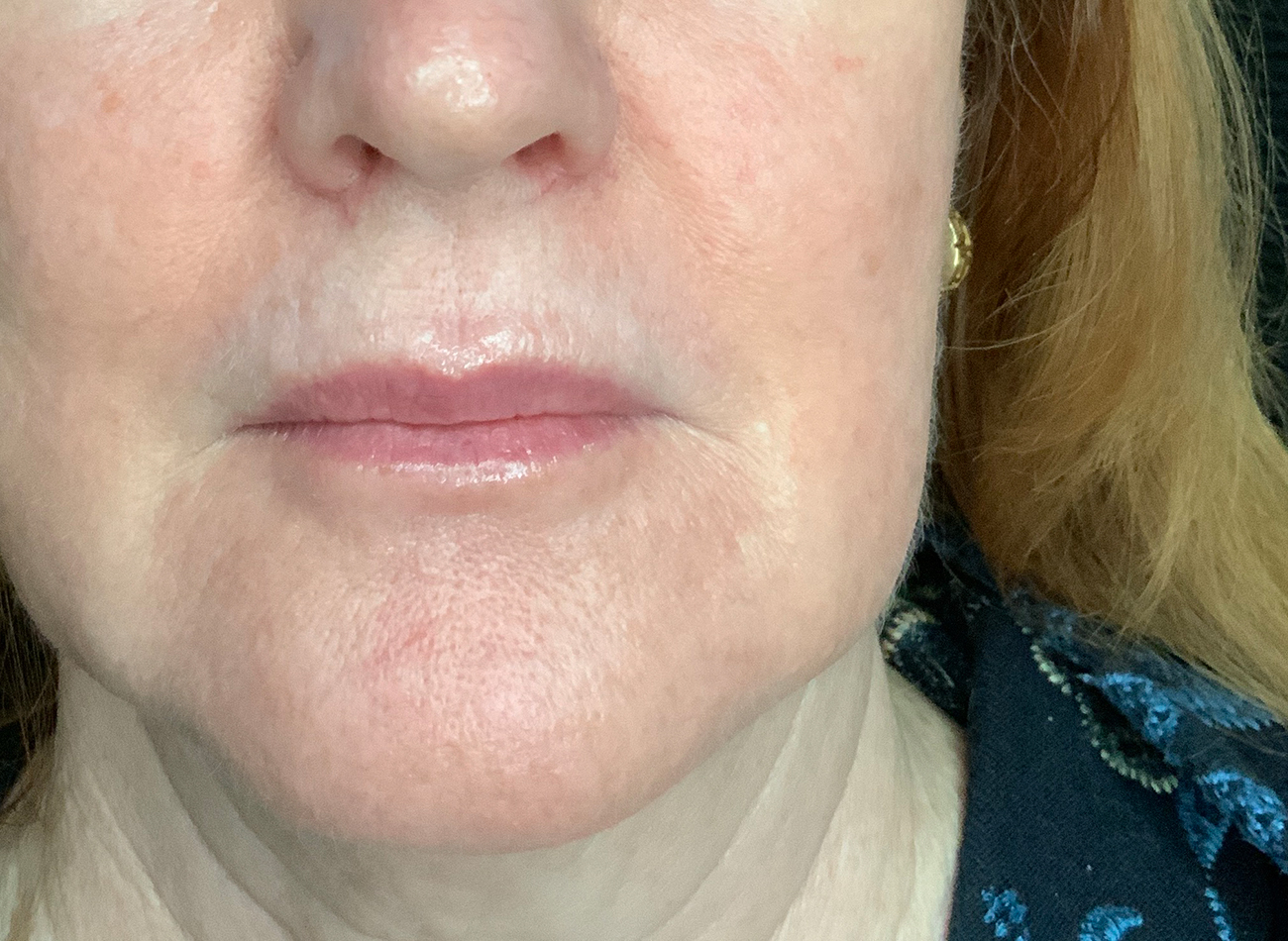 Patient #10465: Juvéderm Ultra Plus After Image