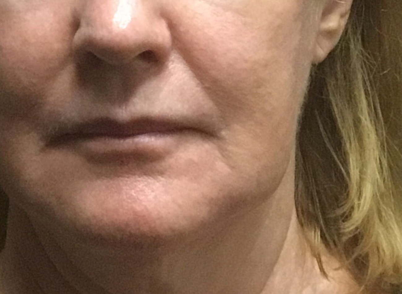 Patient #10465: Juvéderm Ultra Plus Before Image