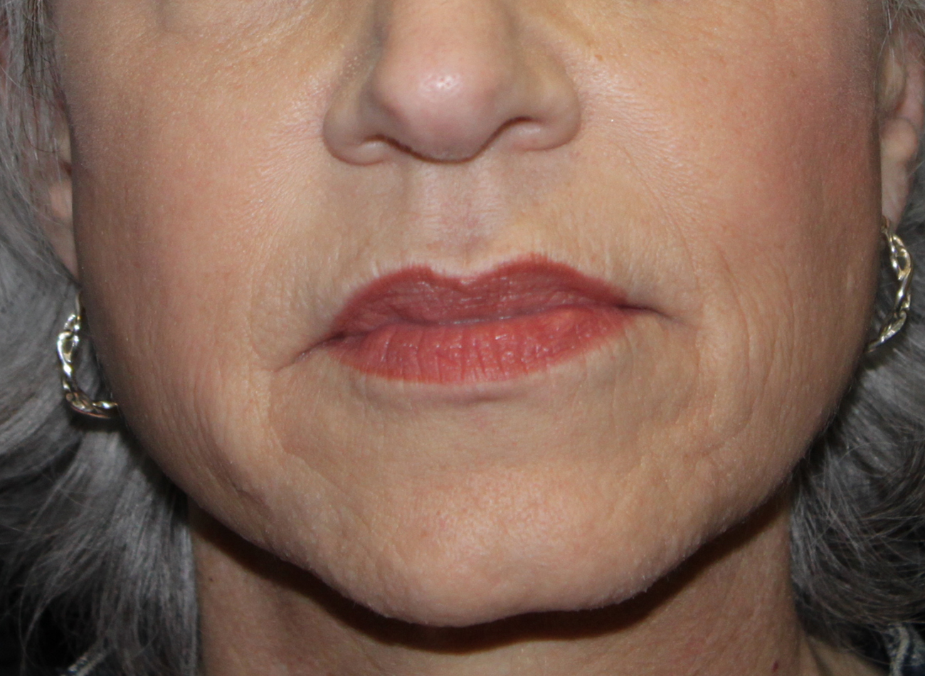 Patient #67047: Juvéderm Ultra Plus After Image