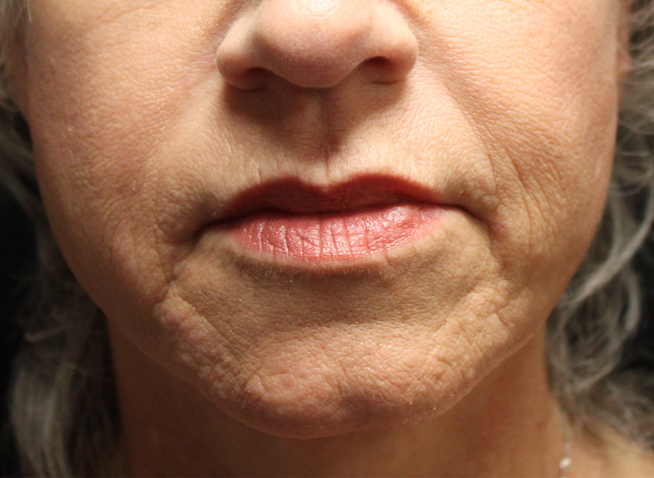 Patient #67047: Juvéderm Ultra Plus Before Image