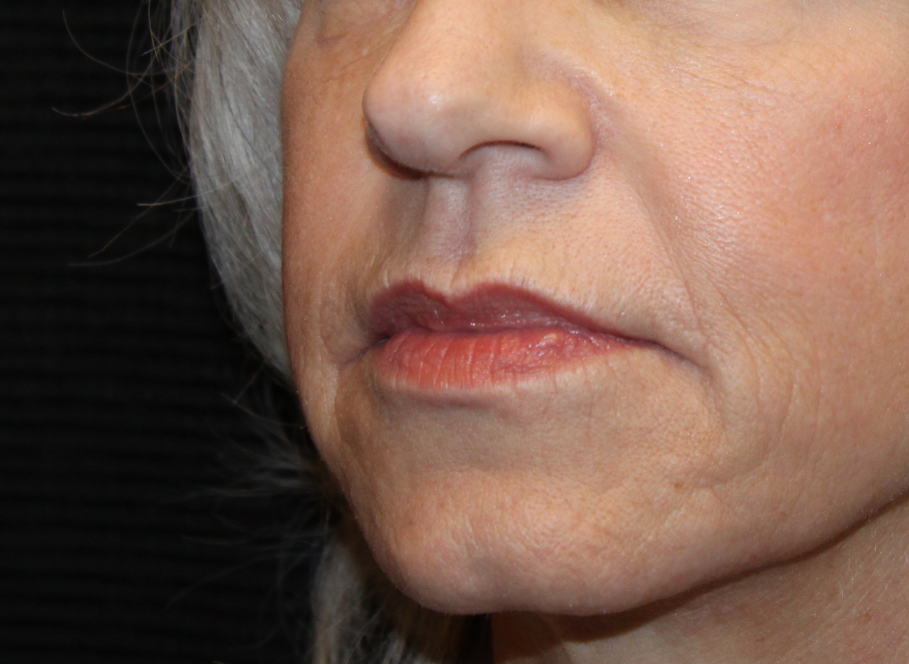 Patient #67047: Juvéderm Ultra Plus After Image