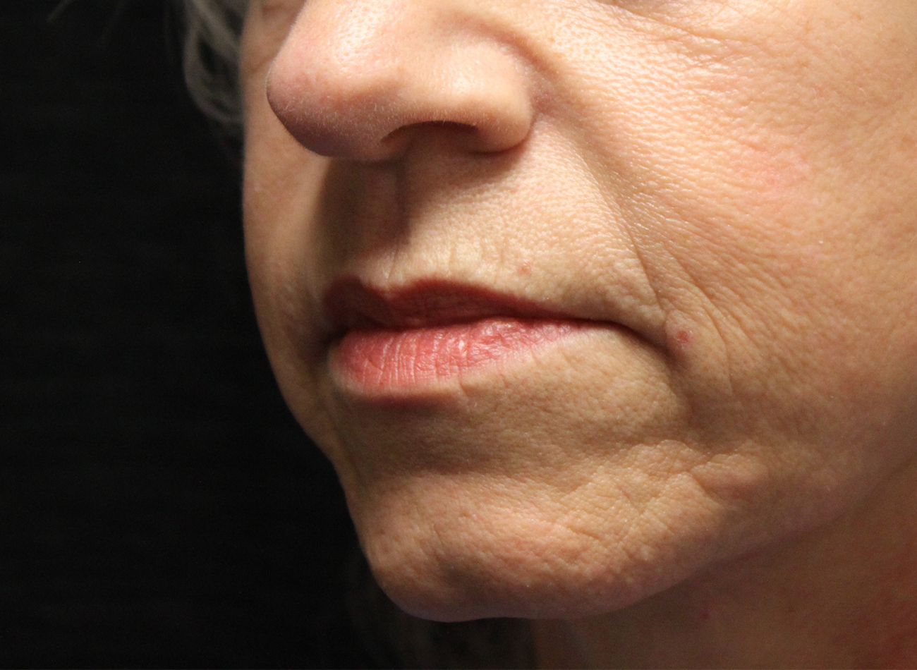 Patient #67047: Juvéderm Ultra Plus Before Image