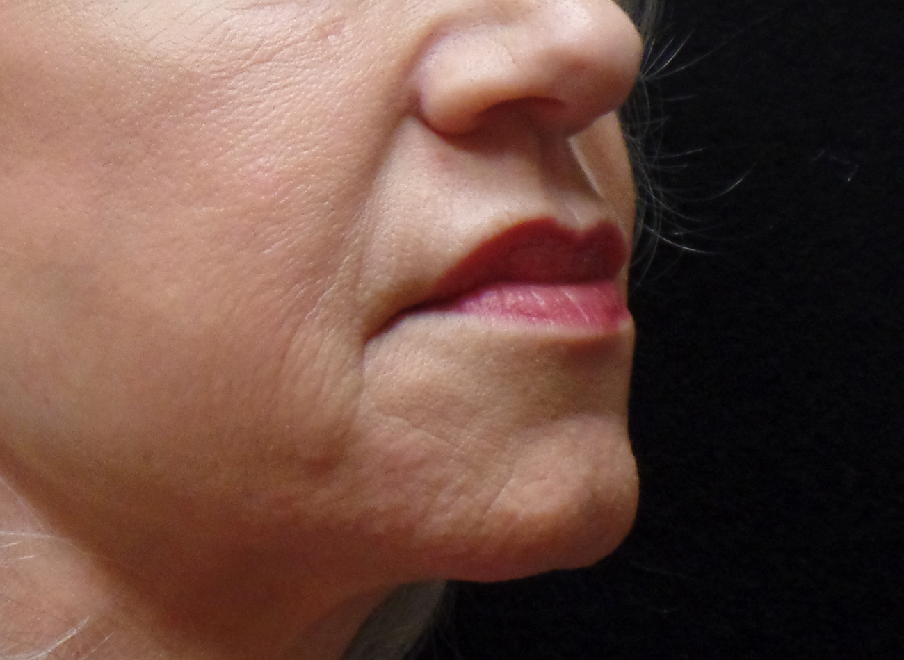 Patient #67047: Juvéderm Ultra Plus After Image