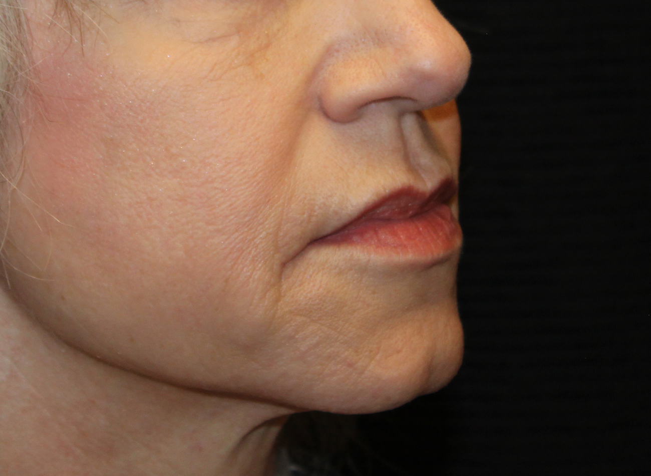 Patient #67047: Juvéderm Ultra Plus Before Image