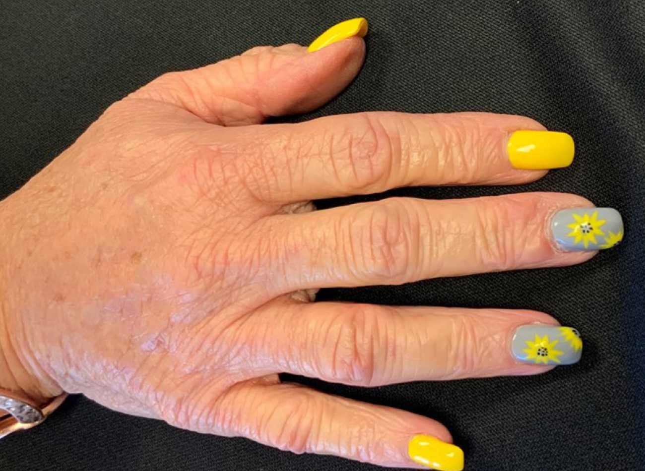 Patient #13014: Hand Rejuvenation After Image