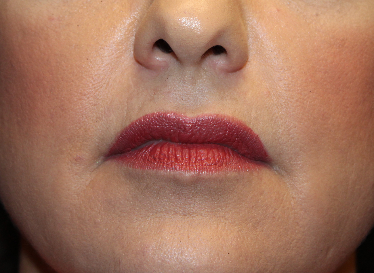 Patient #21940-2: Restylane After Image