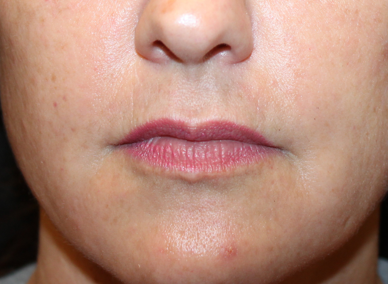 Patient #21940-2: Restylane Before Image