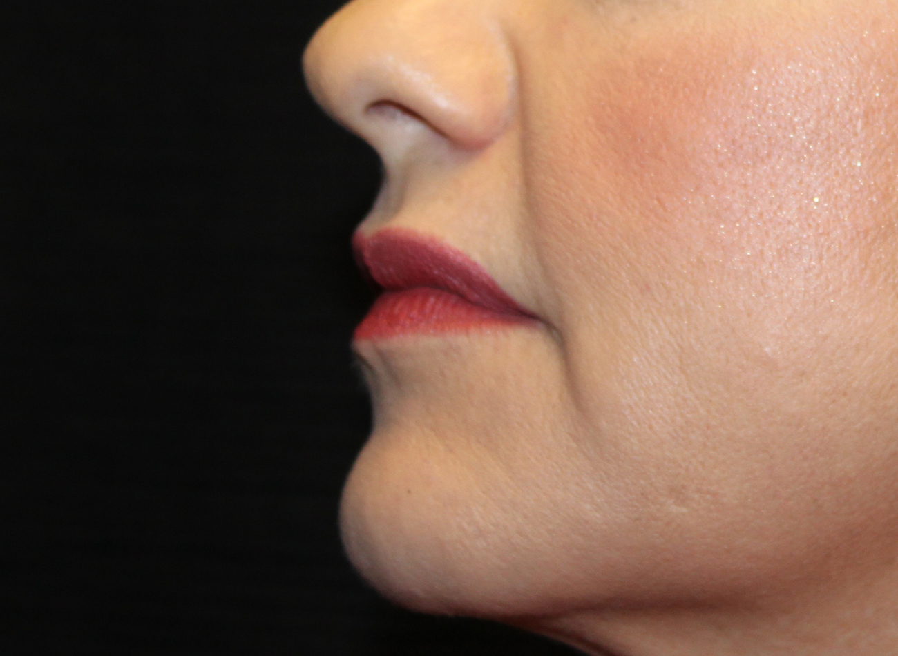 Patient #21940-2: Restylane After Image