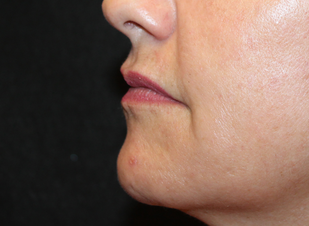 Patient #21940-2: Restylane Before Image
