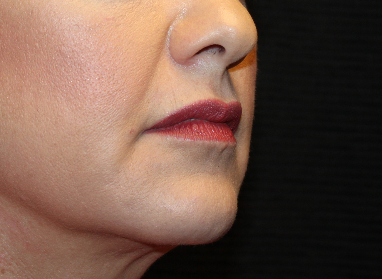 Patient #21940-2: Restylane After Image