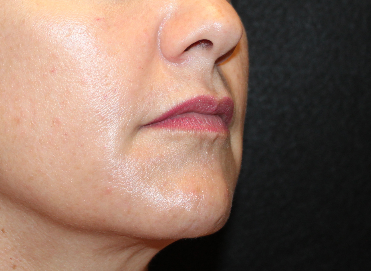 Patient #21940-2: Restylane Before Image