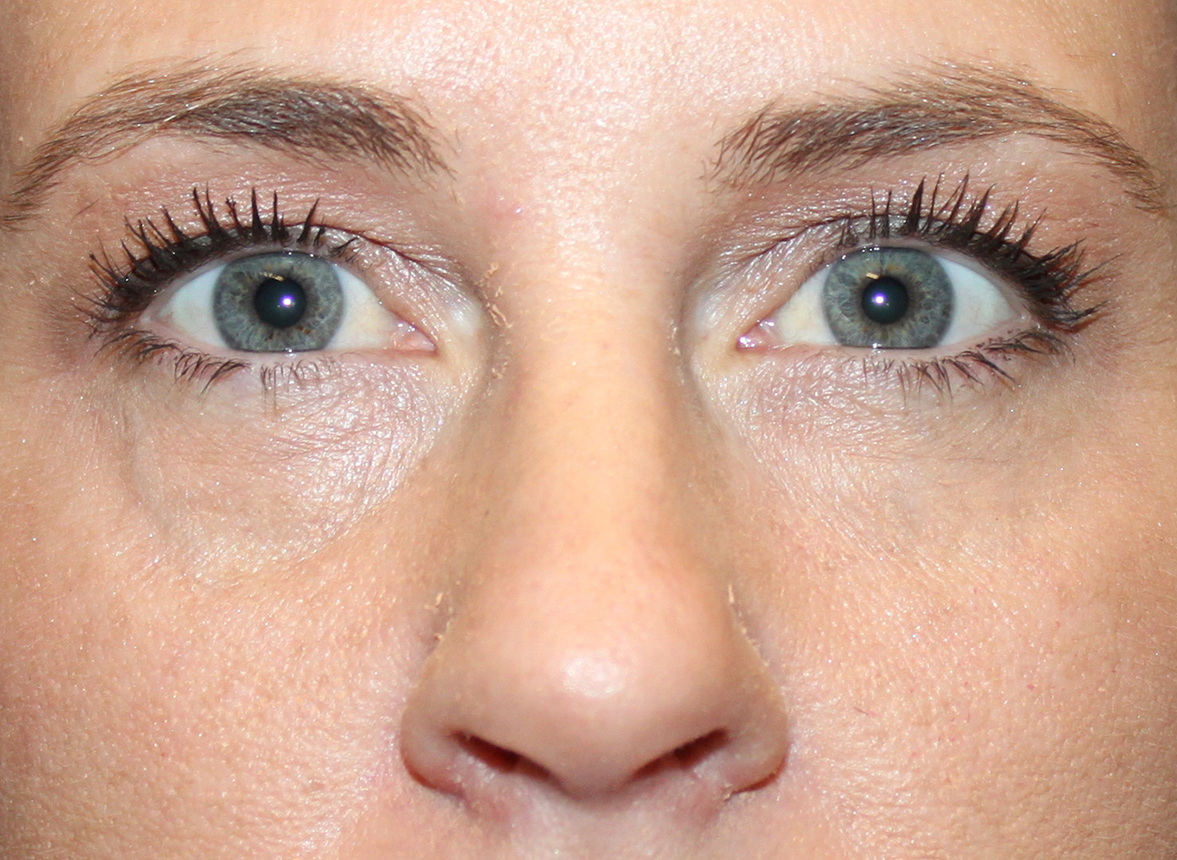 Patient #86966: Restylane After Image