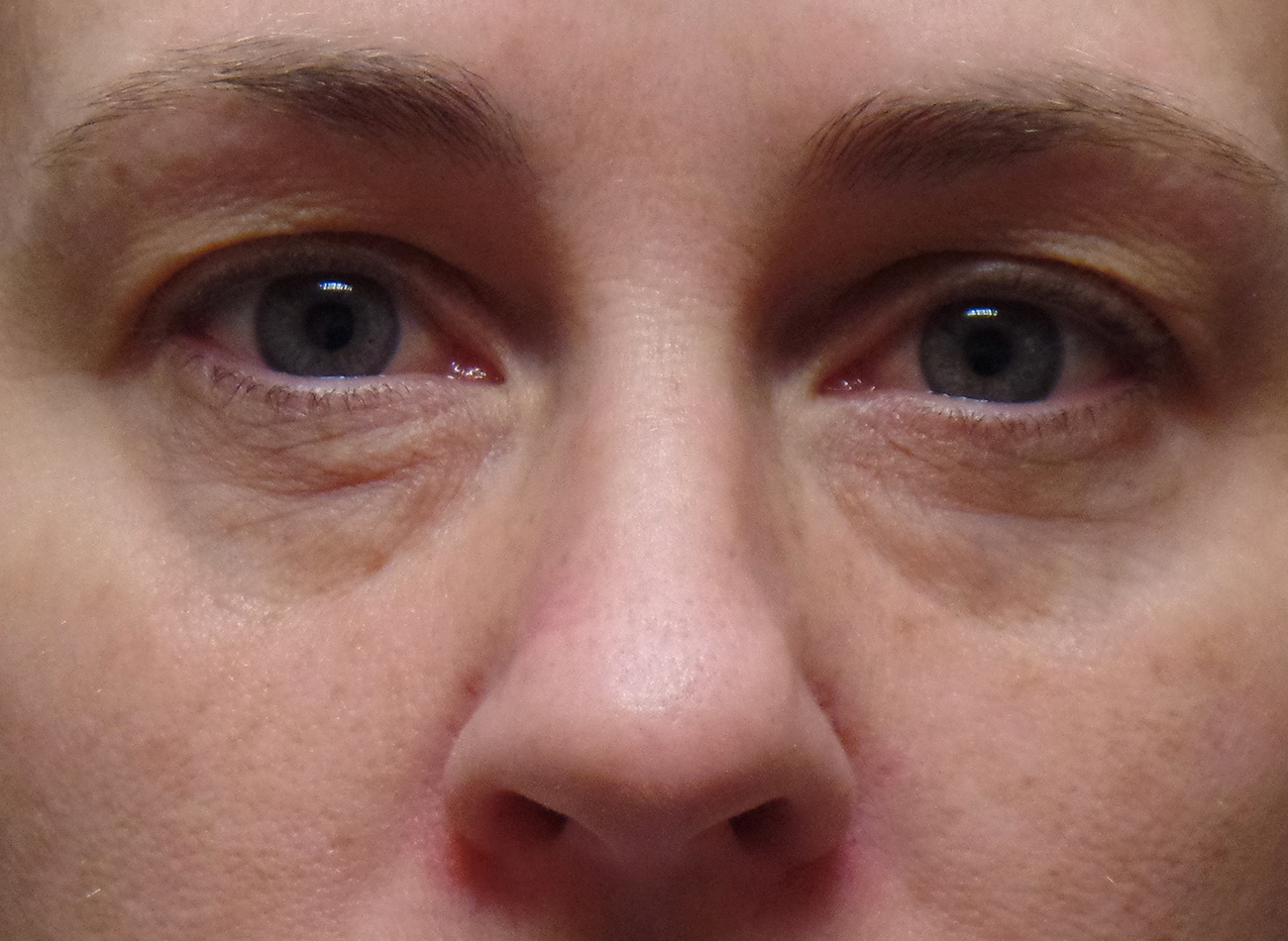 Patient #86966: Restylane Before Image