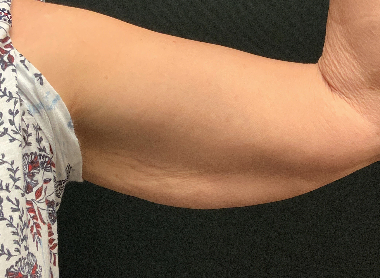 Patient #13290: Skin Tightening with Radiofrequency After Image