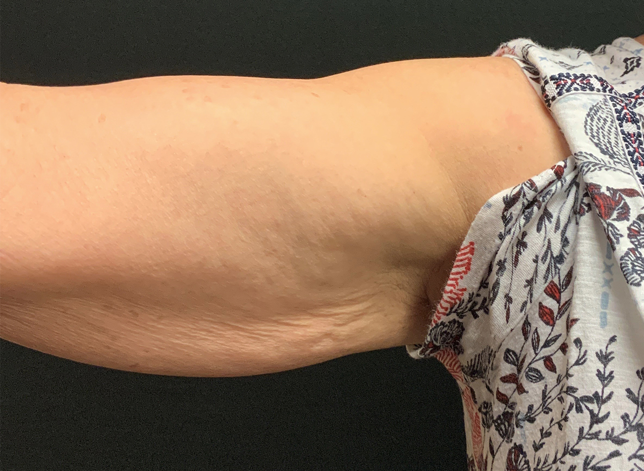 Patient #13290: Skin Tightening with Radiofrequency After Image