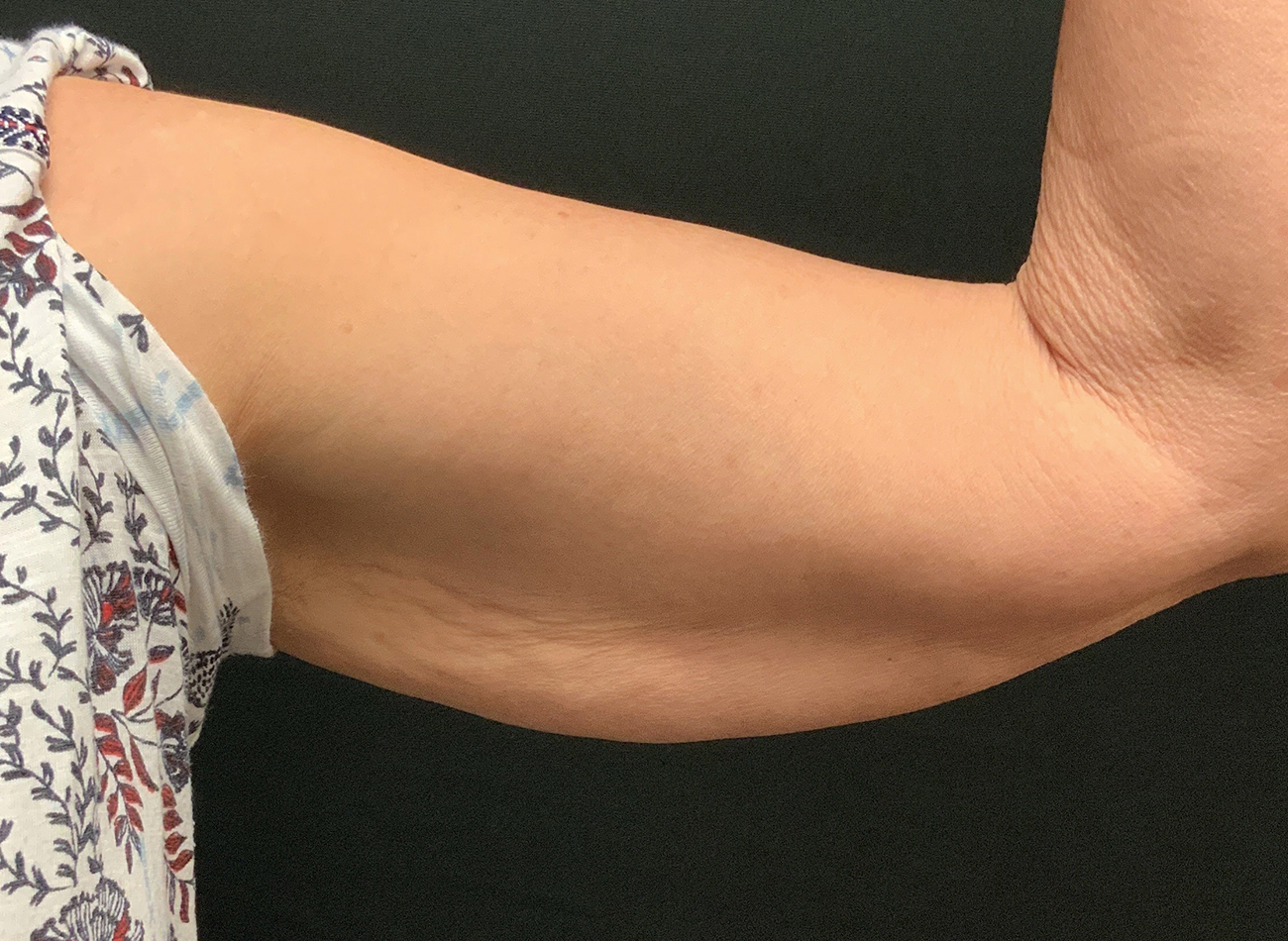 Patient #13290: Skin Tightening with Radiofrequency After Image