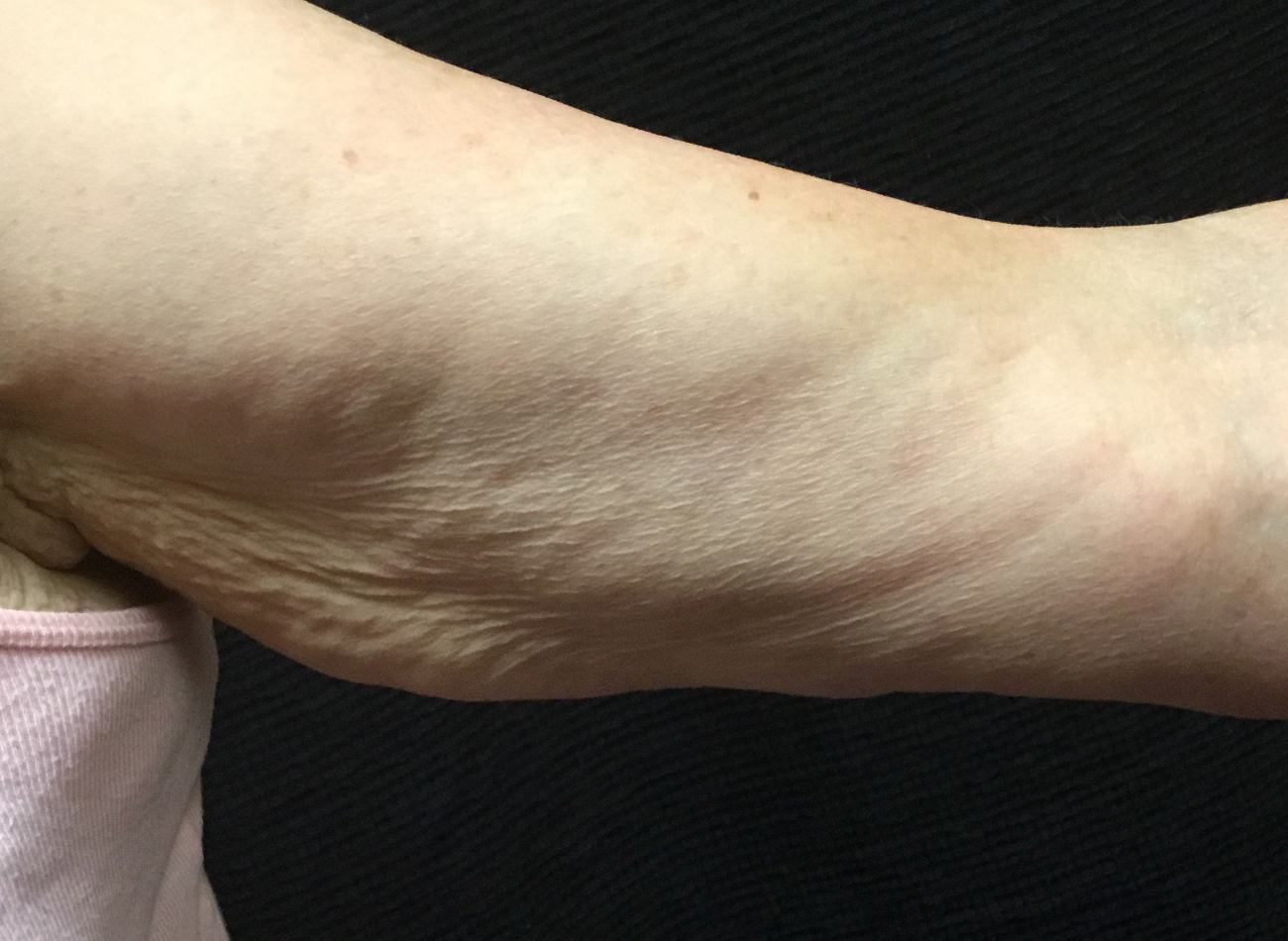 Patient #13290: Skin Tightening with Radiofrequency Before Image