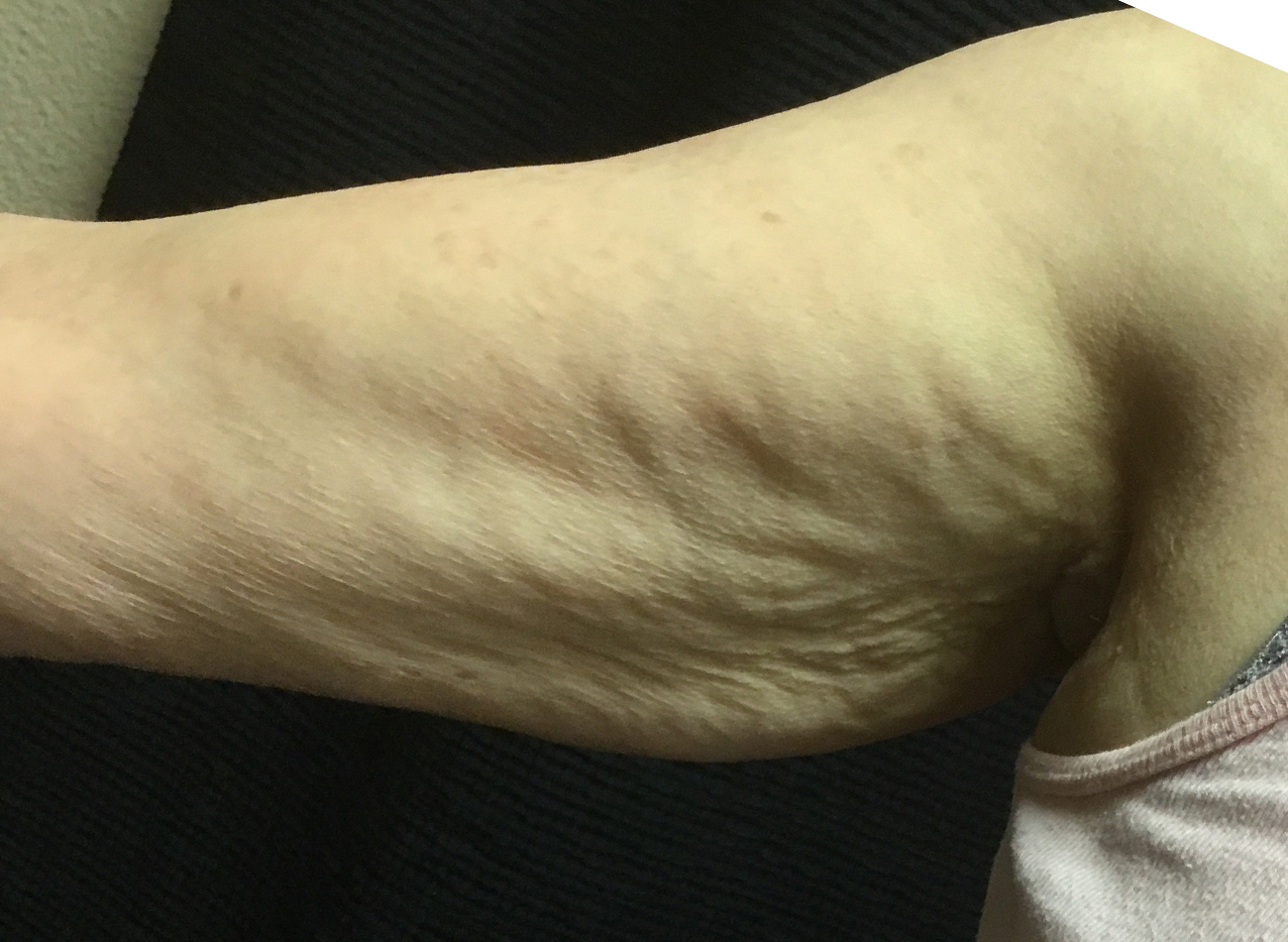 Patient #13290: Skin Tightening with Radiofrequency Before Image
