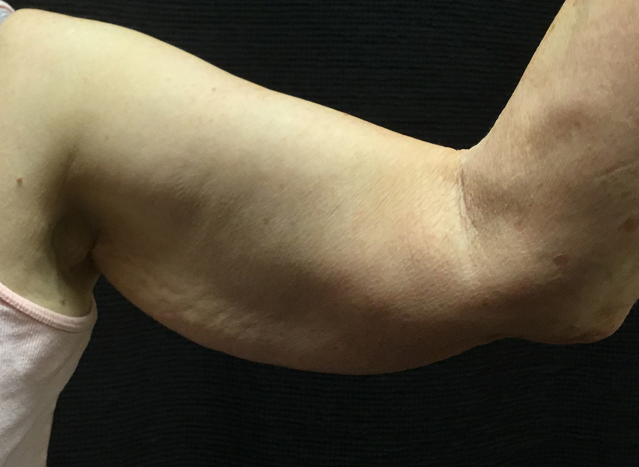 Patient #13290: Skin Tightening with Radiofrequency Before Image