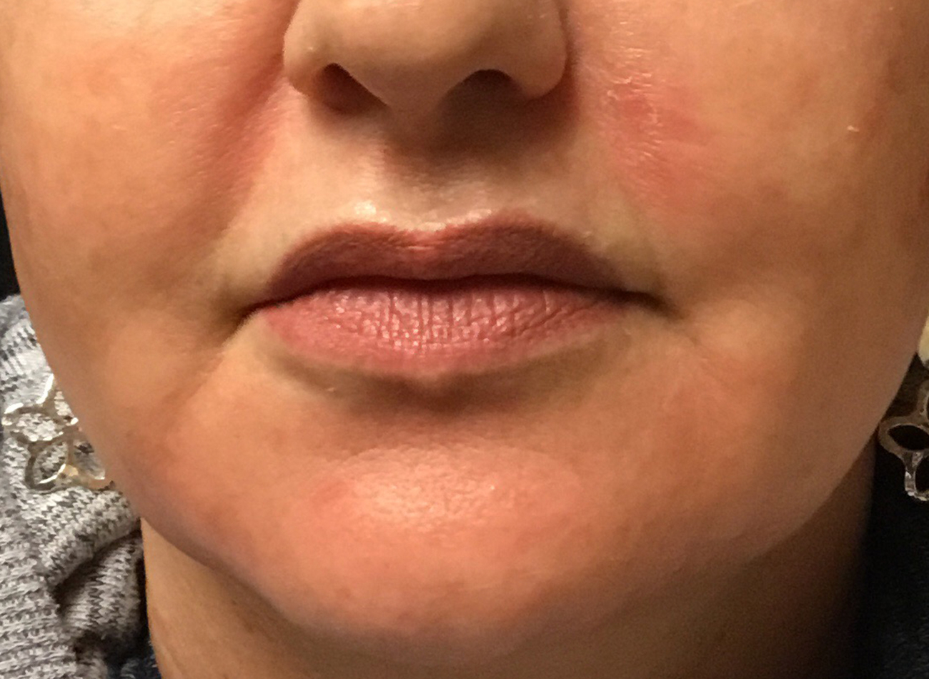 Patient #21940-1: Volbella After Image