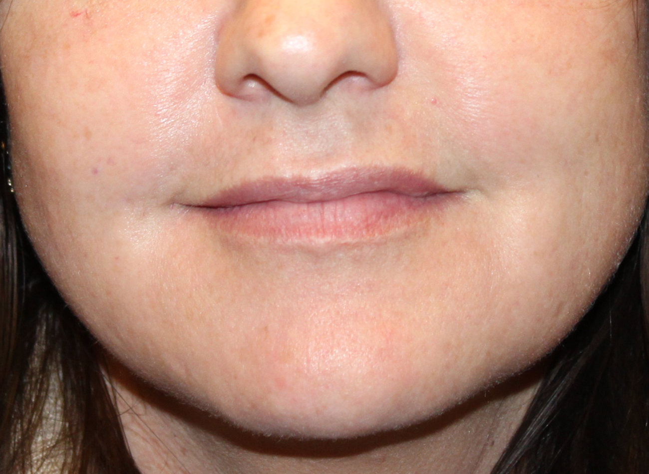 Patient #21940-1: Volbella Before Image