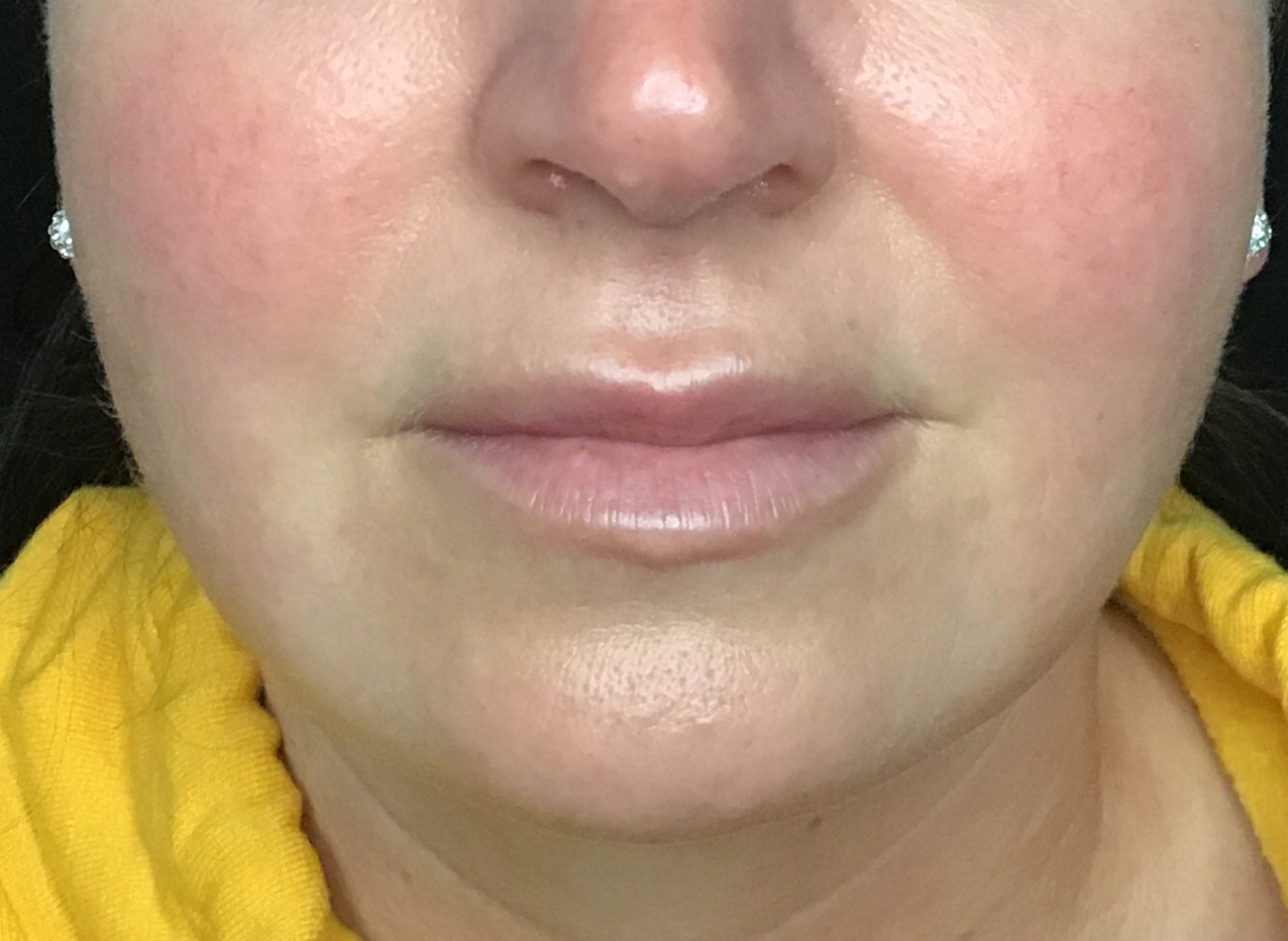 Patient #77848: Volbella After Image