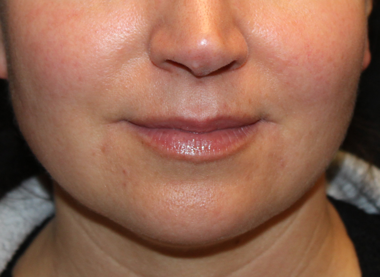 Patient #77848: Volbella Before Image