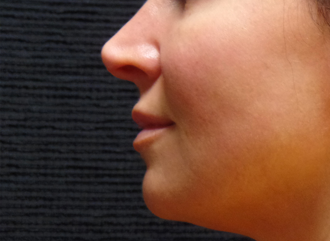 Patient #77848: Volbella After Image