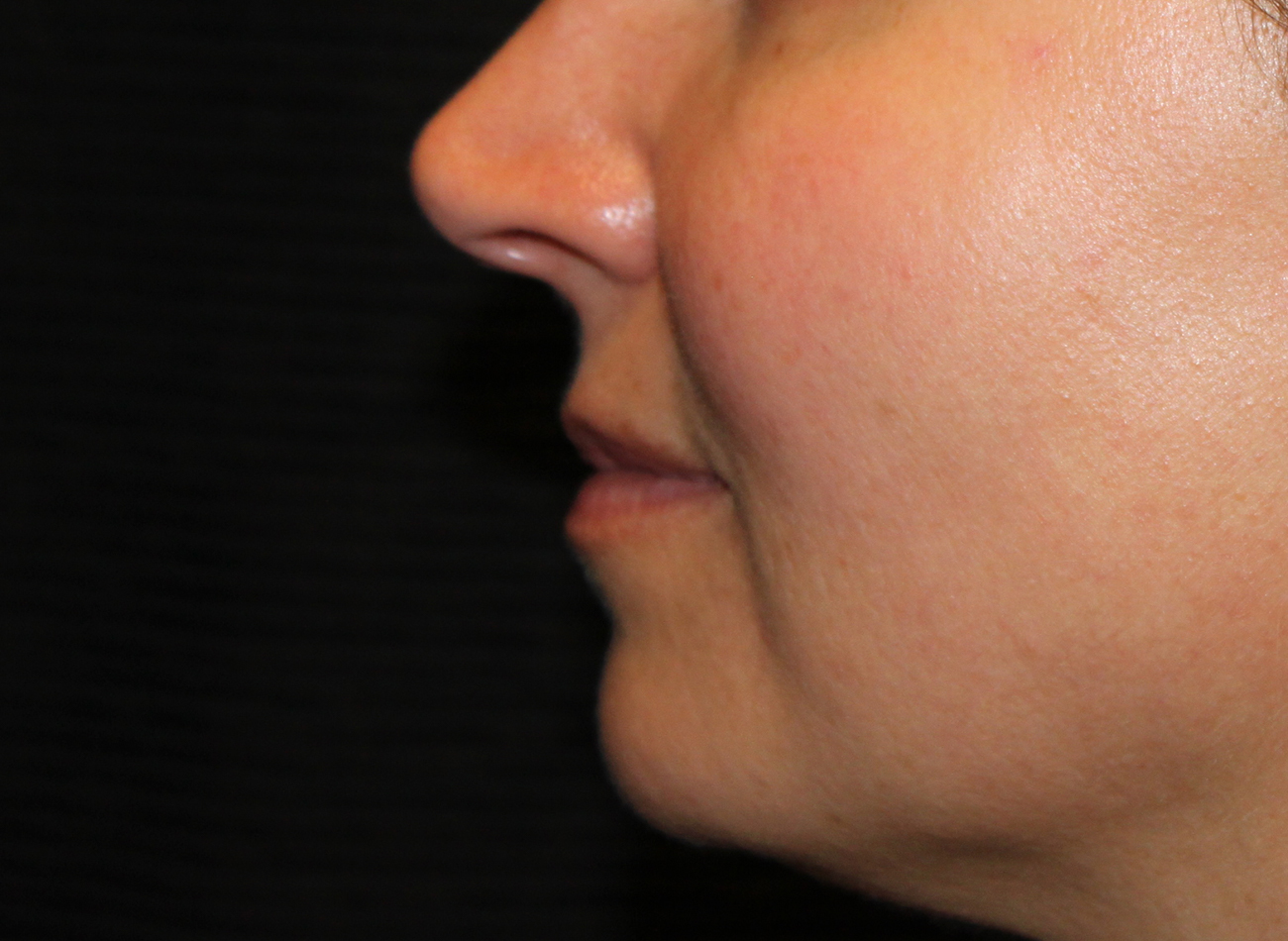 Patient #77848: Volbella Before Image