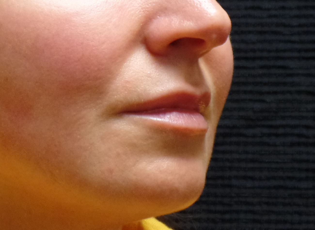 Patient #77848: Volbella After Image