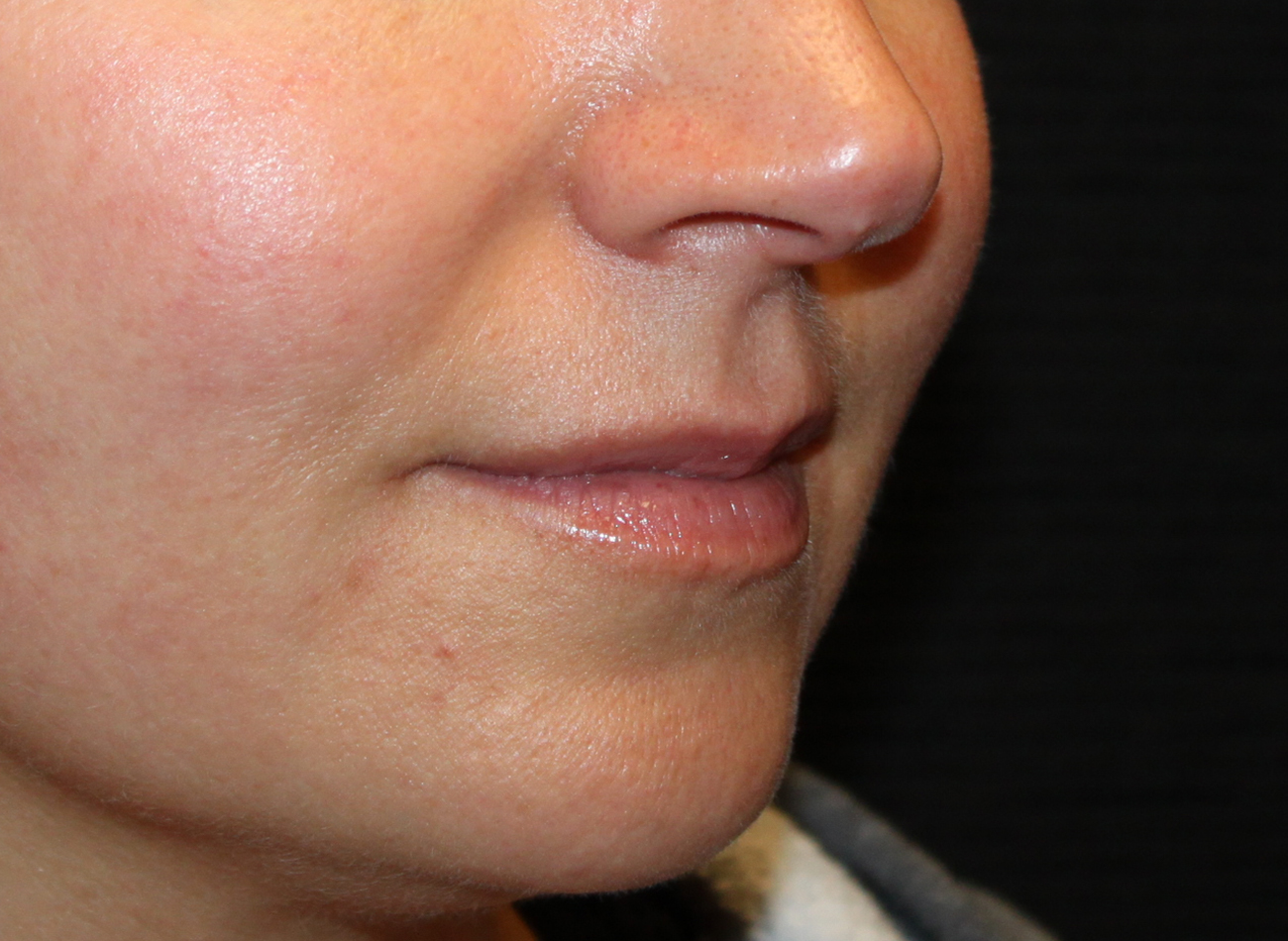 Patient #77848: Volbella Before Image