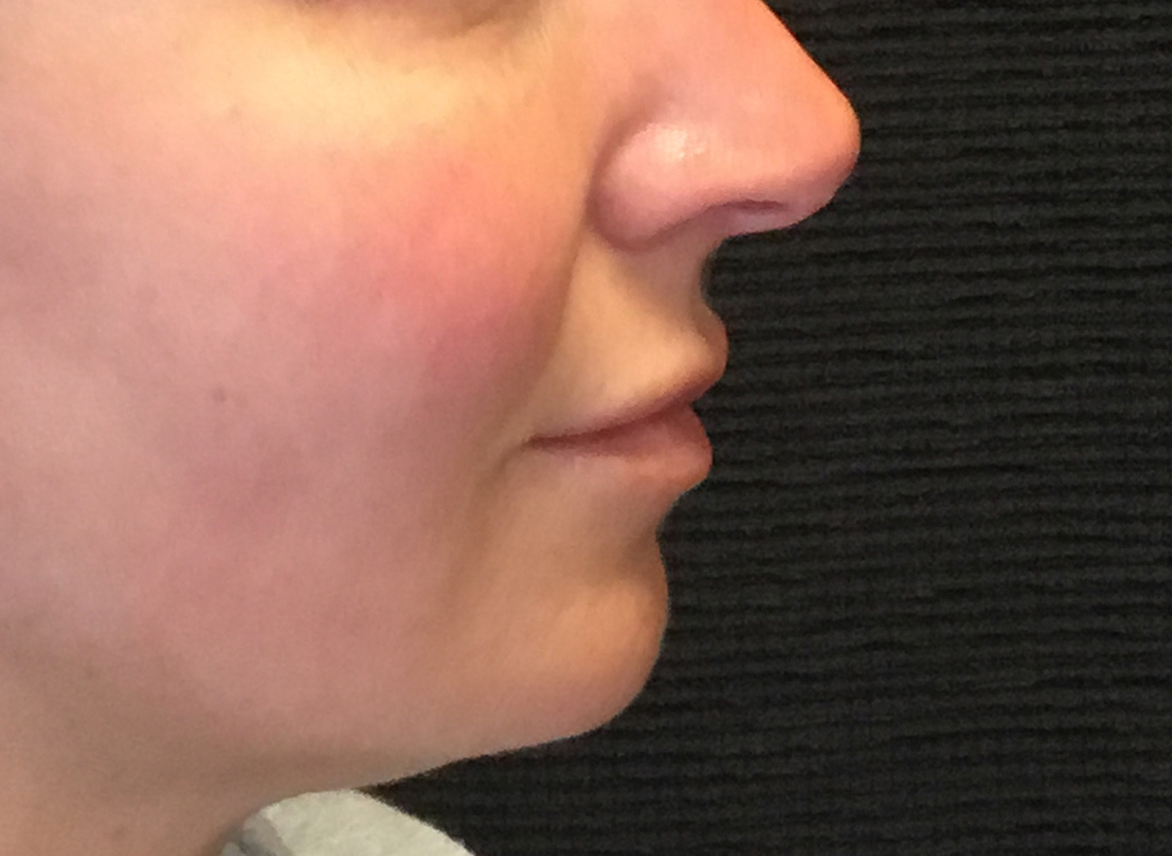 Patient #77848: Volbella After Image