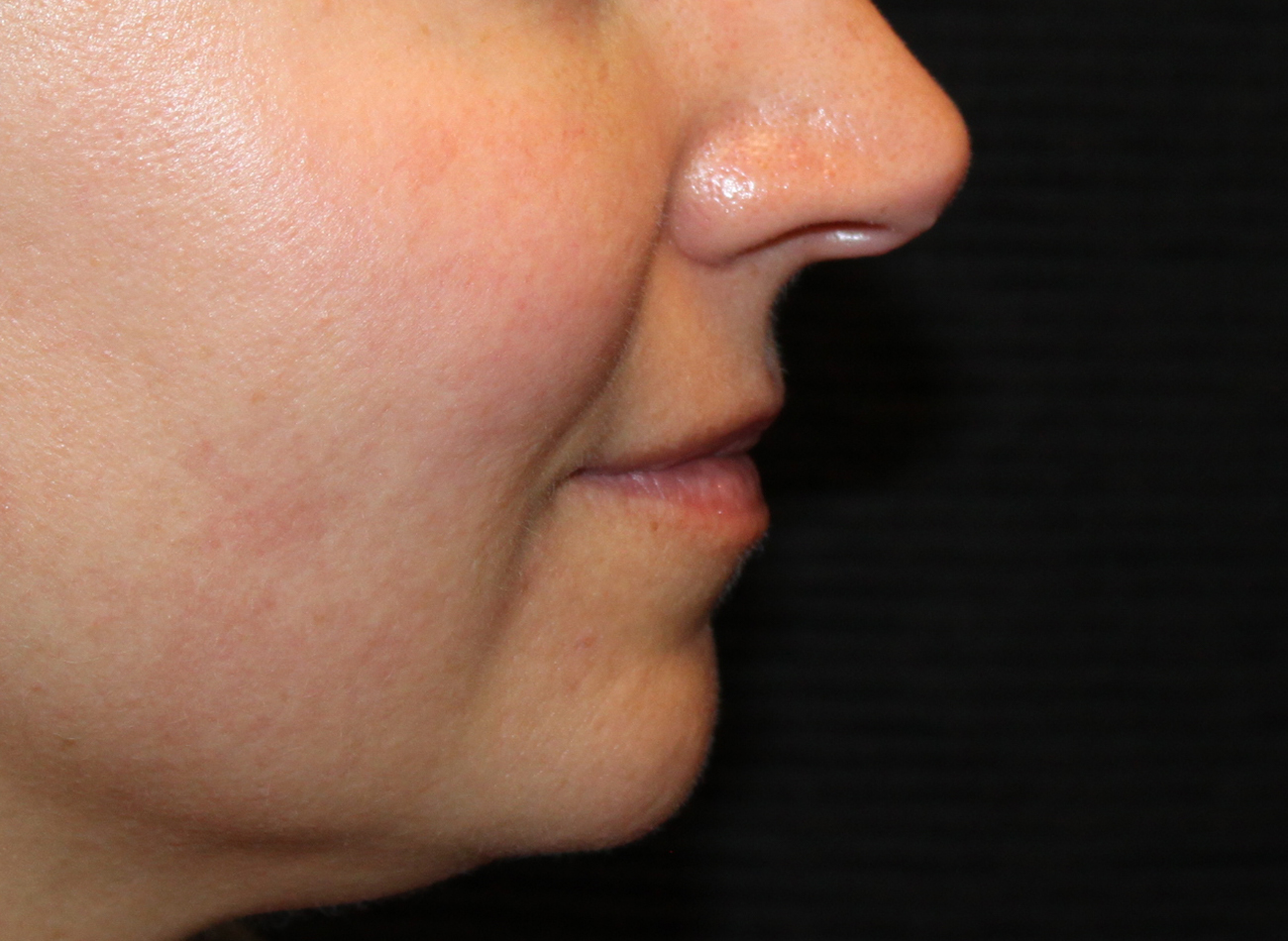 Patient #77848: Volbella Before Image