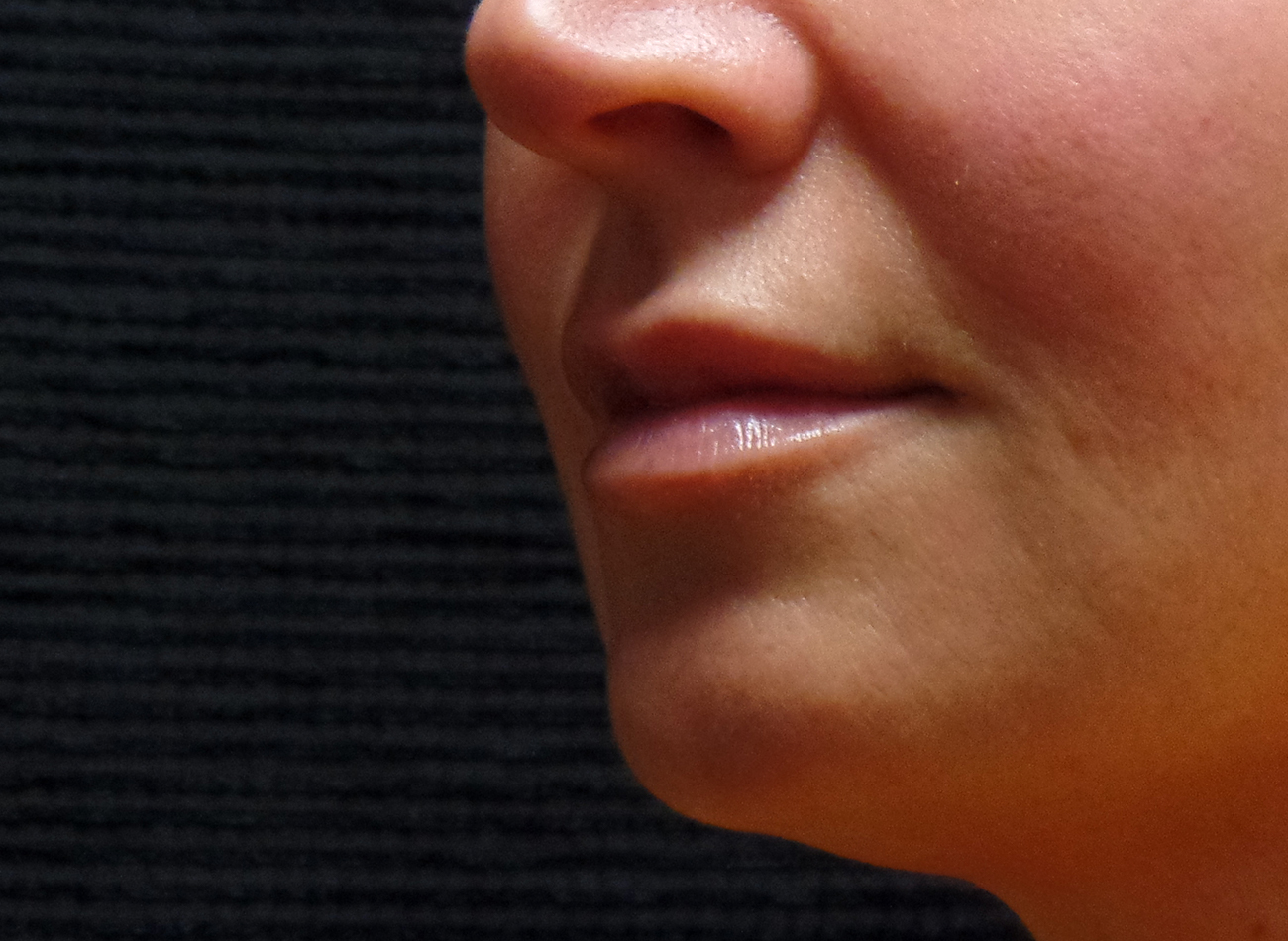 Patient #77848: Volbella After Image