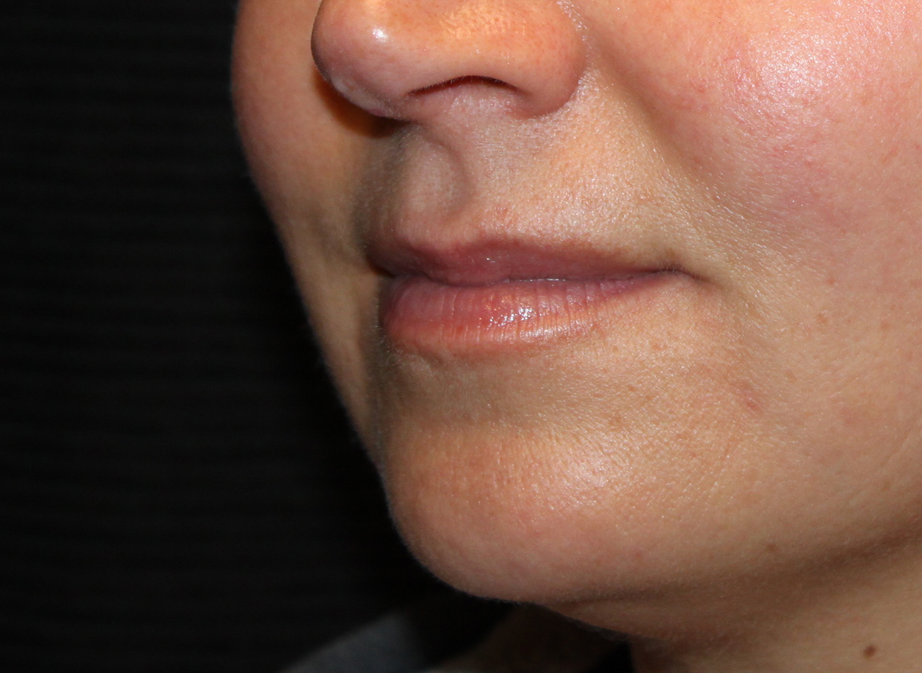 Patient #77848: Volbella Before Image