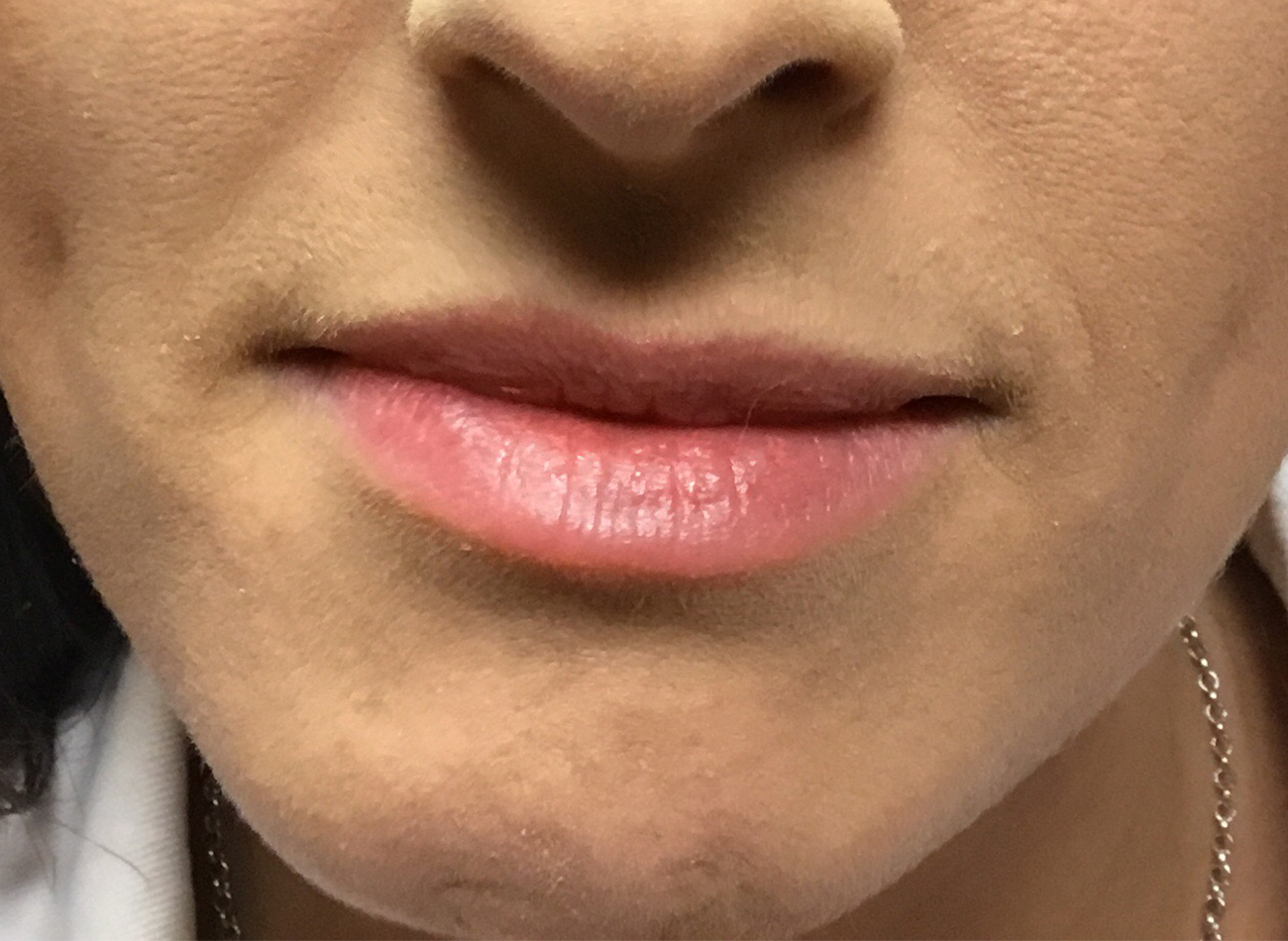 Patient #95269: Volbella After Image