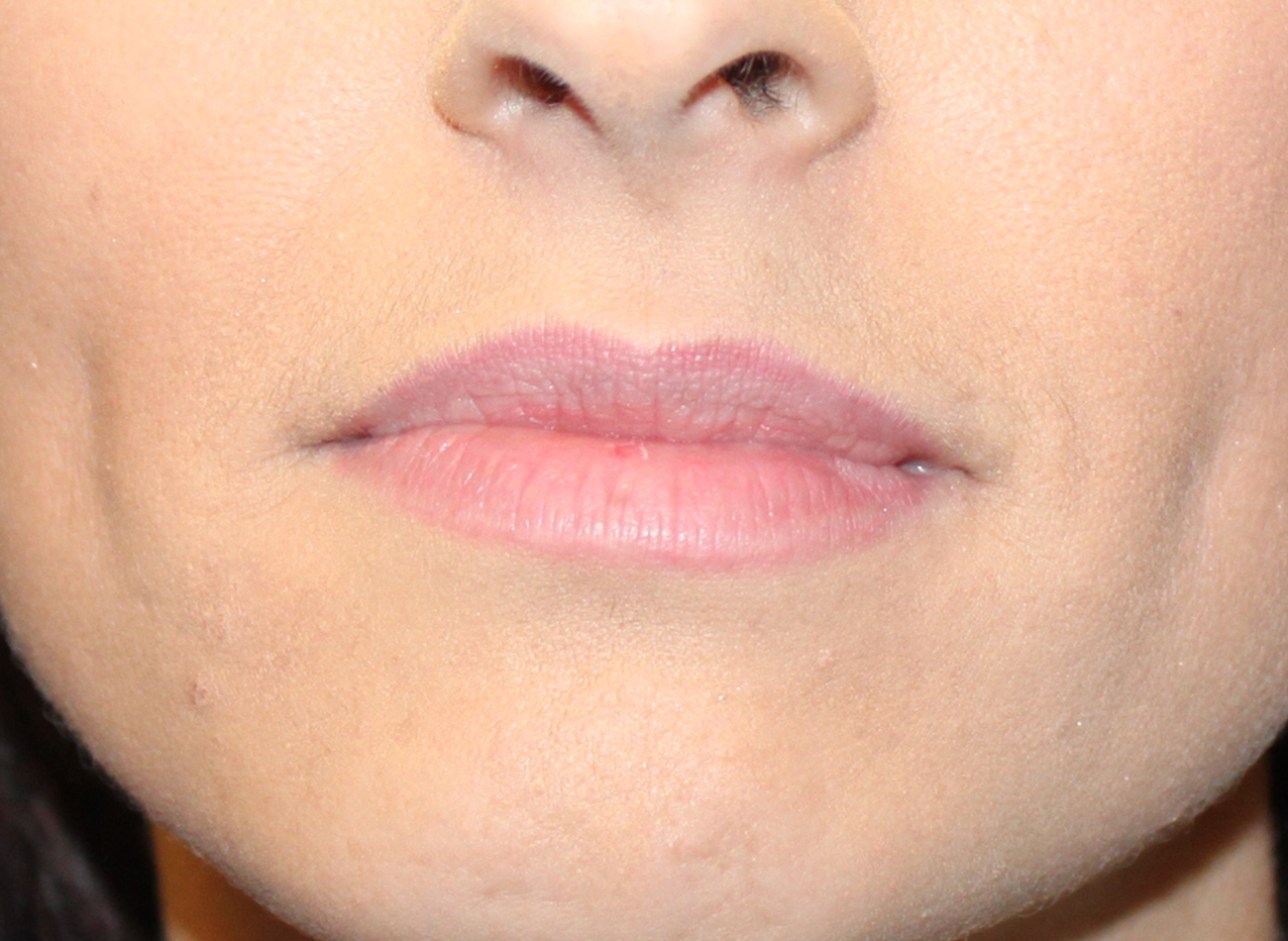 Patient #95269: Volbella Before Image