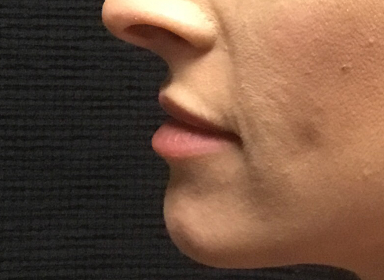 Patient #95269: Volbella After Image