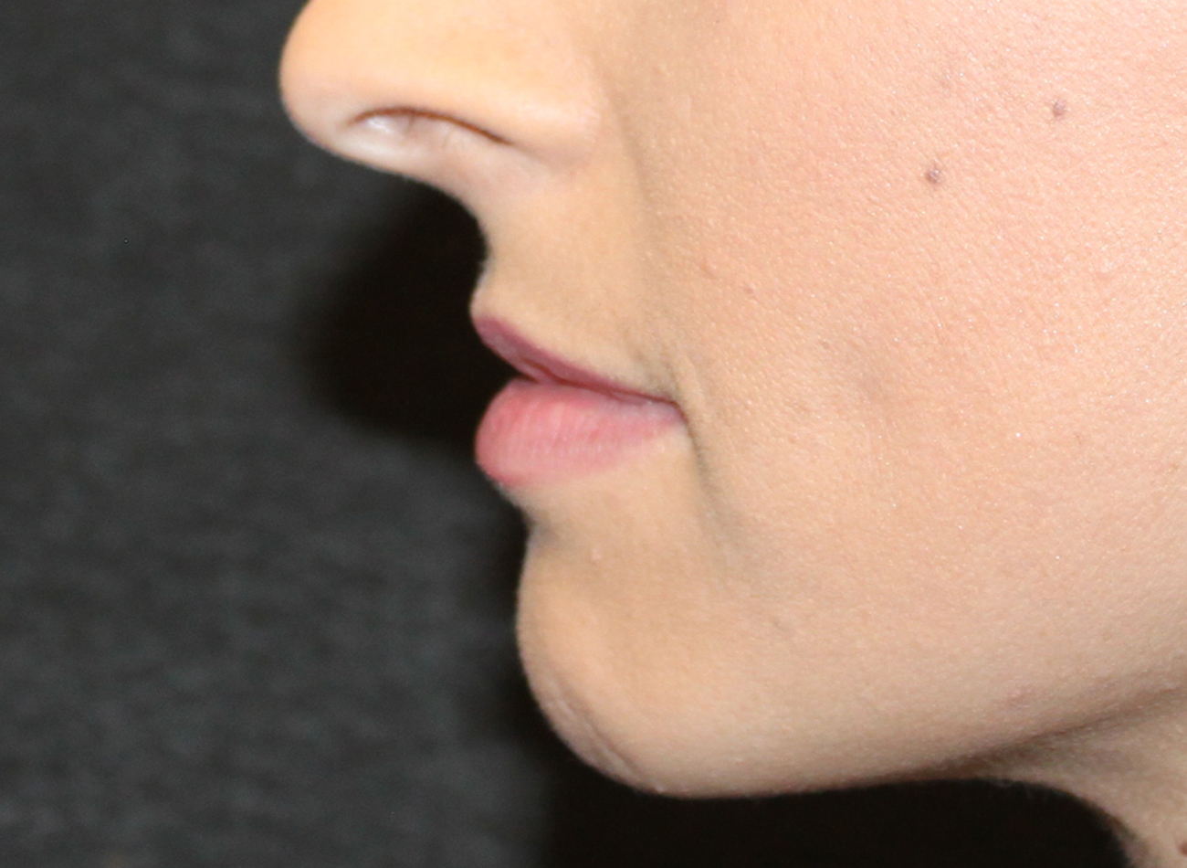 Patient #95269: Volbella Before Image