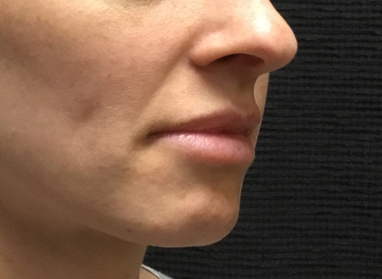 Patient #95269: Volbella After Image