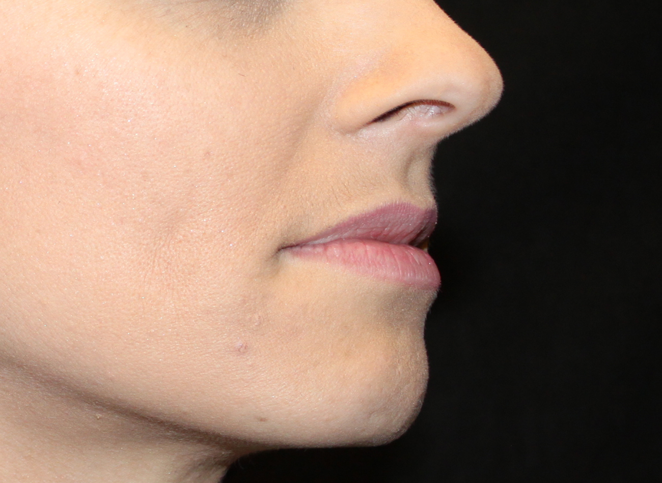 Patient #95269: Volbella Before Image