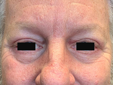 Patient #79785: Blepharoplasty After Image