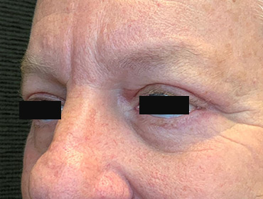 Patient #79785: Blepharoplasty After Image