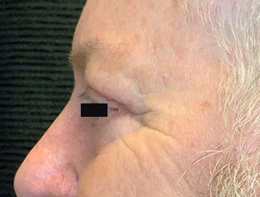 Patient #79785: Blepharoplasty After Image
