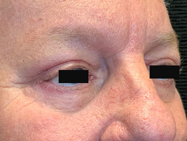 Patient #79785: Blepharoplasty After Image