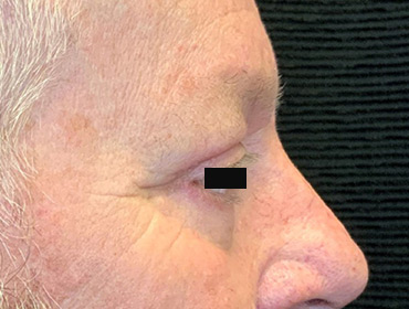 Patient #79785: Blepharoplasty After Image