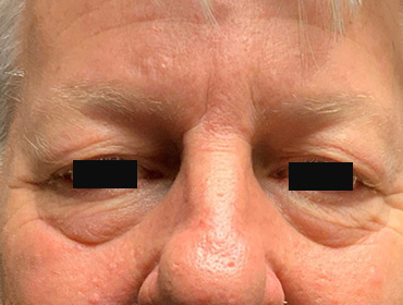 Patient #79785: Blepharoplasty Before Image