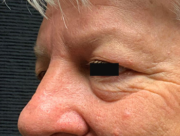 Patient #79785: Blepharoplasty Before Image